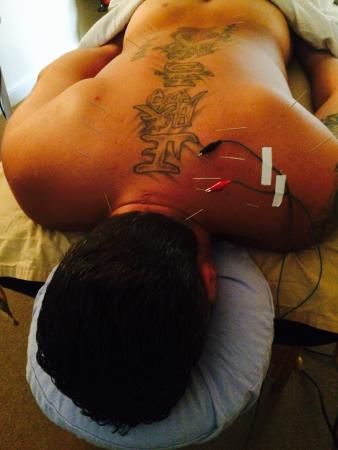 AcuSportsTherapy Acupuncture Delray Beach (561)303-3436