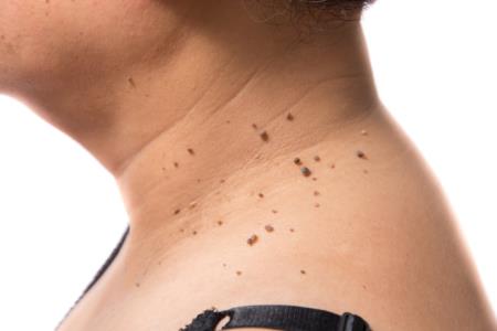 skin tag removal just $15 Arona Health & Beauty Spa Scarborough (416)701-0090