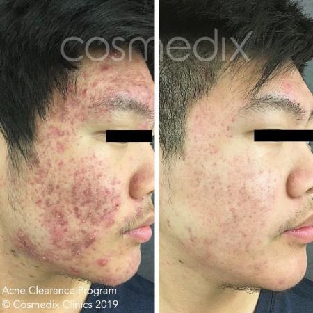 acne clearance results Cosmedix Clinics Darlinghurst (02) 8006 3344