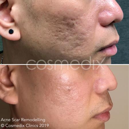 acne scar remodelling results  Cosmedix Clinics Darlinghurst (02) 8006 3344