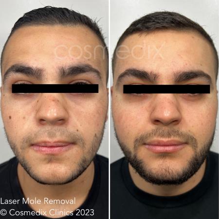 laser mole removal Cosmedix Clinics Darlinghurst (02) 8006 3344