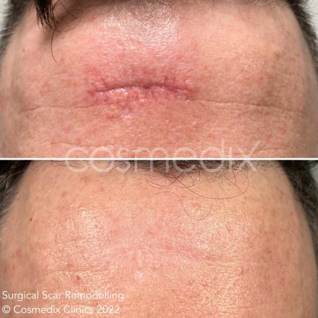surgical scar revision results Cosmedix Clinics Darlinghurst (02) 8006 3344