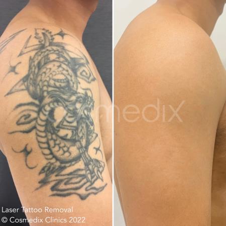 laser tattoo removal results Cosmedix Clinics Darlinghurst (02) 8006 3344