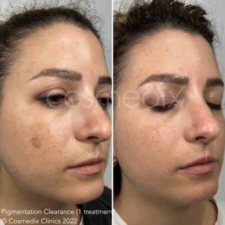 laser pigmentation clearance results Cosmedix Clinics Darlinghurst (02) 8006 3344