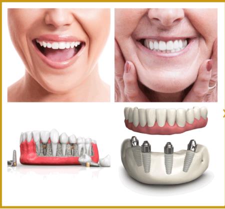 TCare Dental Centre - Dentist Campsie | All On 4 Implants | Orthodontics | Cosmetic Veneers - Campsi Campsie (02) 8766 6699