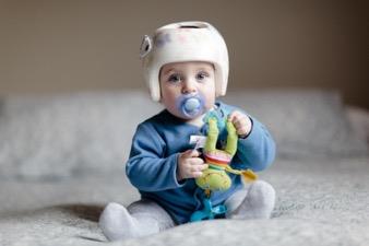 custom made cranial helmets for babies with plagiocephaly or brachycephaly. Custom Orthotic Design Group Ltd Mississauga (905)828-2969