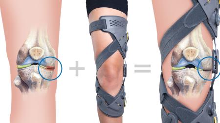 custom made knee bracing for arthritis and ligament injuries help you reduce pain and get back to your activities. Custom Orthotic Design Group Ltd Mississauga (905)828-2969