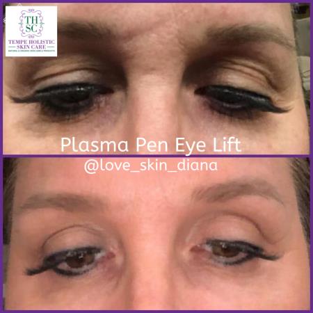 plasma pen eye lift Love Skin Holistic Medical Spa Tempe (480)378-6203