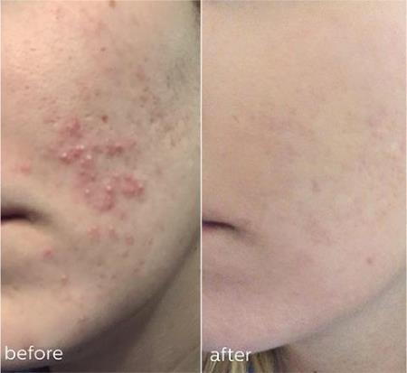 acne treatment, chemical peel before and after Love Skin Holistic Medical Spa Tempe (480)378-6203