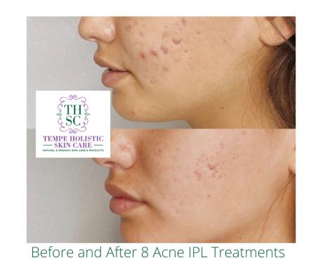 acne ipl treatment Love Skin Holistic Medical Spa Tempe (480)378-6203